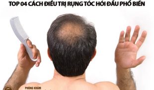 Giải pháp trị rụng tóc hói đầu hiệu quả cho cả nam và nữ – Bạn đừng bỏ lỡ!