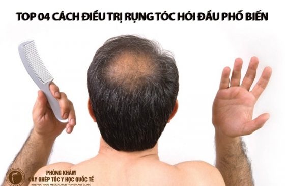 điều trị rụng tóc hói đầu, cách trị rụng tóc hói đầu, cách trị rụng tóc gây hói đầu, cách trị rụng tóc do hói đầu, trị rụng tóc với hói đầu,