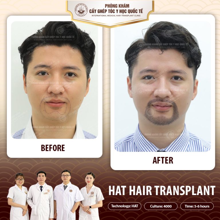 Cấy râu tự thân là gì? Chi phí cấy râu giá bao nhiêu? Địa chỉ cấy râu ...