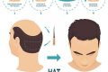 cấy tóc tự thân hat