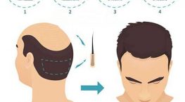 cấy tóc tự thân hat