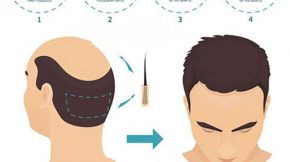 cấy tóc tự thân hat
