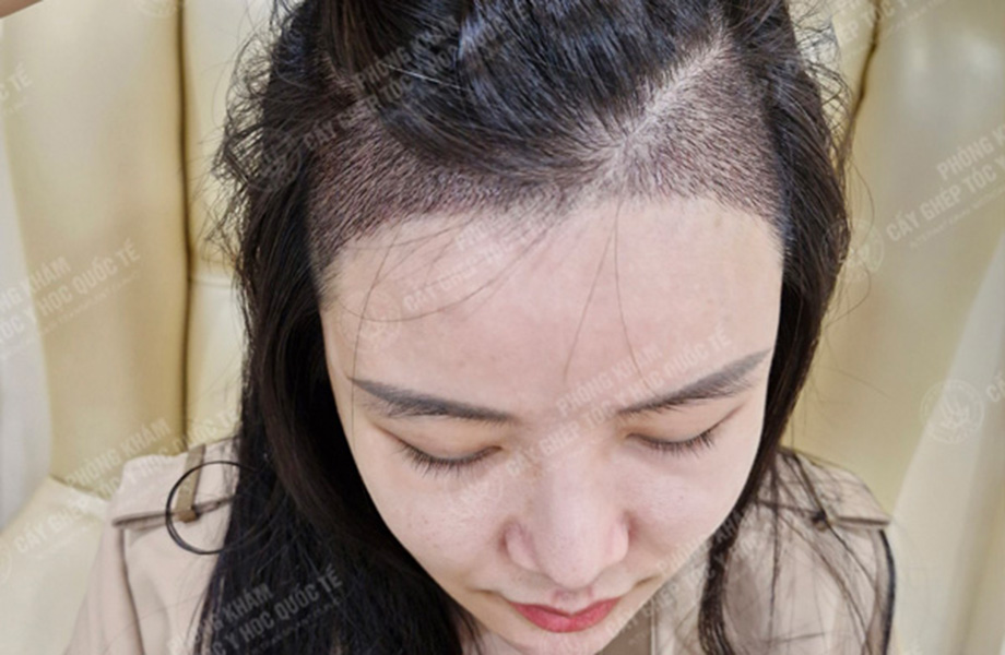 Nguyễn Vân Anh - Cấy tóc tự thân 7