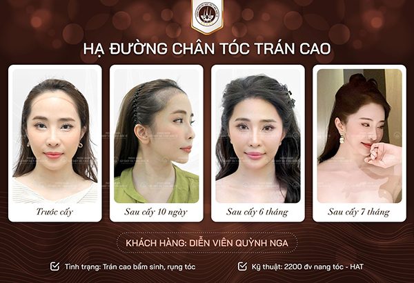TOP 5 Dầu gội ngăn ngừa rụng tóc cho nữ được chuyên gia khuyên dùng