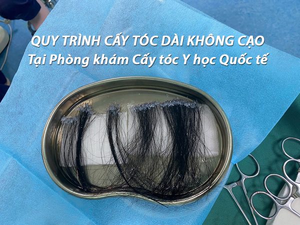 cấy tóc dài không cạo pns