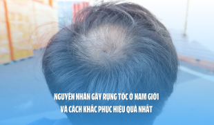 Nguyên nhân gây rụng tóc ở nam giới và cách khắc phục hiệu quả nhất 