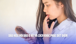 Dấu hiệu hói đầu ở nữ và cách khắc phục dứt điểm