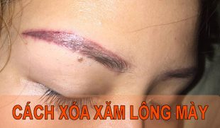 Bật mí cách xóa xăm lông mày không để lại sẹo