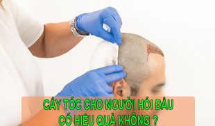 Tìm hiểu cấy tóc cho người hói có thực sự hiệu quả không?