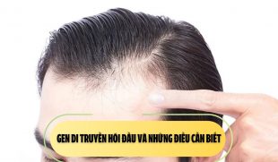 Gen di truyền hói đầu và những điều cần biết