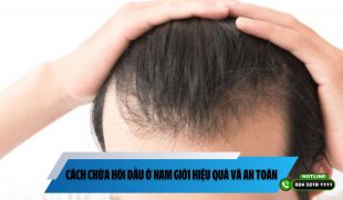 Cách chữa hói đầu ở nam giới hiệu quả và an toàn, nên áp dụng ngay 