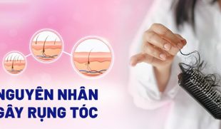 [Tìm Hiểu]: Những nguyên nhân gây rụng tóc và bí quyết giúp tóc nhanh mọc lại