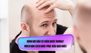 Bệnh hói đầu có chữa được không? Mách bạn cách khắc phục hiệu quả nhất