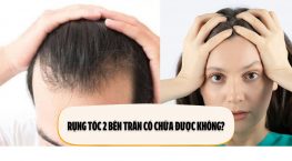 Rụng tóc 2 bên trán có chữa được không?