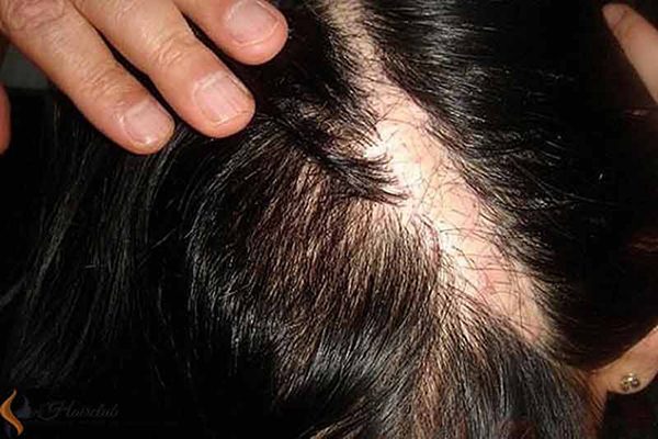 Vết sẹo trên đầu có mọc được tóc không? Chuyên gia giải đáp chi tiết