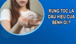 [TÌM HIỂU] :  RỤNG TÓC LÀ TRIỆU CHỨNG CỦA BỆNH GÌ ?