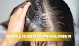 Hói đỉnh đầu nữ: dấu hiệu nhận biết, nguyên nhân và cách điều trị! 