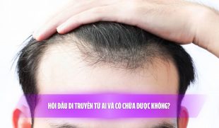 Hói đầu di truyền từ ai và có chữa được không? 