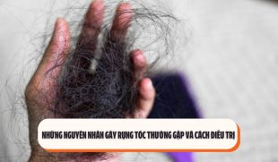 Những nguyên nhân gây rụng tóc thường gặp và cách điều trị 