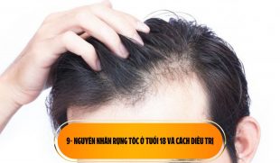 9+ Nguyên nhân rụng tóc ở tuổi 18 và cách điều trị