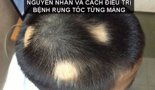 Nguyên nhân gây bệnh rụng tóc từng mảng và cách điều trị dứt điểm