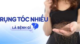 Rụng tóc là dấu hiệu của bệnh gì? Cách khắc phục rụng tóc bệnh lý hiệu quả