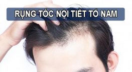 Dấu hiệu nhận biết và cách điều trị rụng tóc nội tiết tố nam hiệu quả