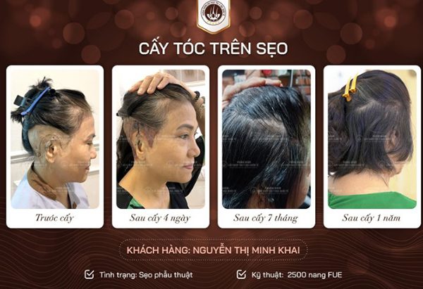 Vết sẹo trên đầu có mọc được tóc không? Chuyên gia giải đáp chi tiết