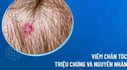 Viêm nang chân tóc: Nguyên nhân, triệu chứng và cách điều trị hiệu quả