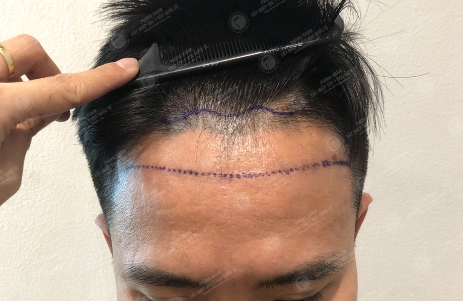 Phùng Gia Tuấn - Cấy tóc đường chữ M 2