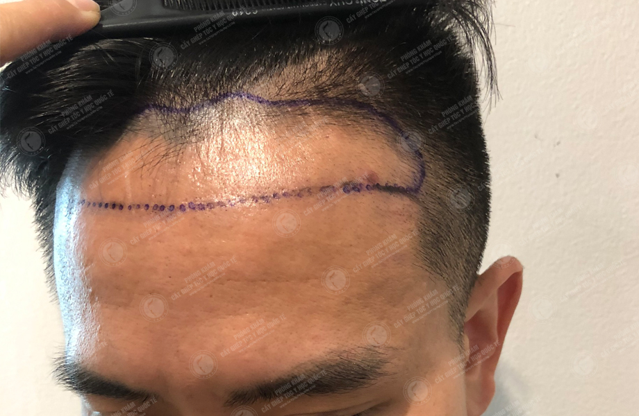 Phùng Gia Tuấn - Cấy tóc đường chữ M 3