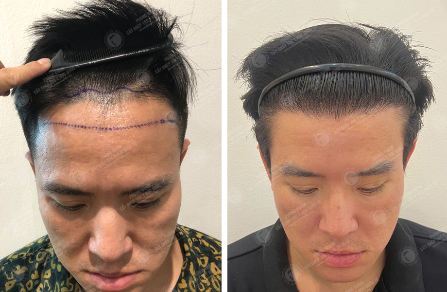  Phùng Gia Tuấn - Cấy tóc đường chữ M 1