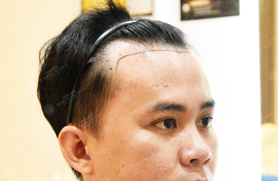 Trương Ngọc Huy - Cấy tóc đường chữ M 2
