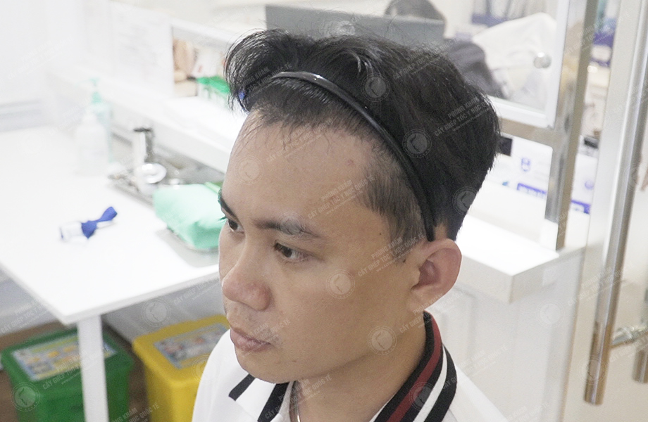Trương Ngọc Huy - Cấy tóc đường chữ M 5