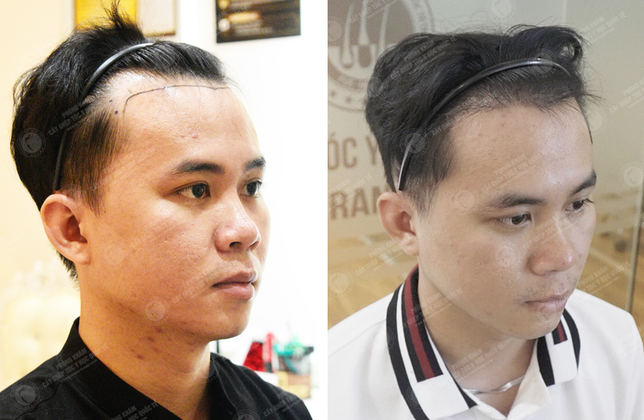  Trương Ngọc Huy - Cấy tóc tự thân 1