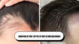 Khám phá sự thật: Cấy tóc có thực sự hiệu quả không?