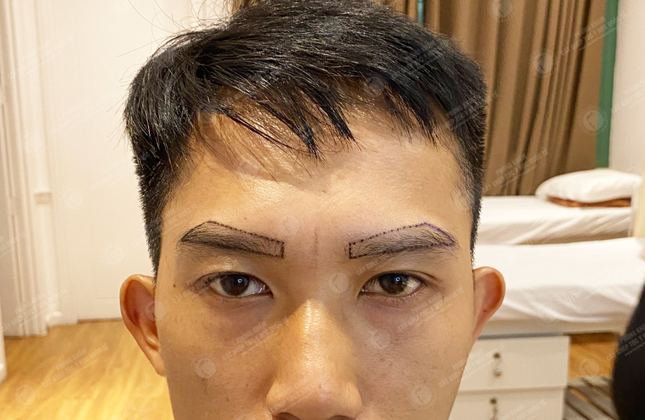 Hoàng Duy Phong - Cấy lông mày 2