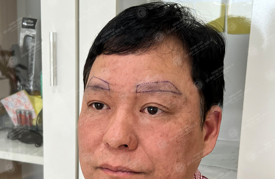 Phạm Tấn Sơn - Cấy lông mày 3