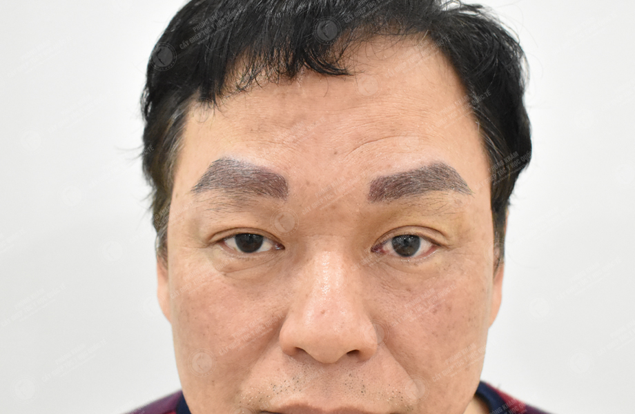 Phạm Tấn Sơn - Cấy lông mày 5