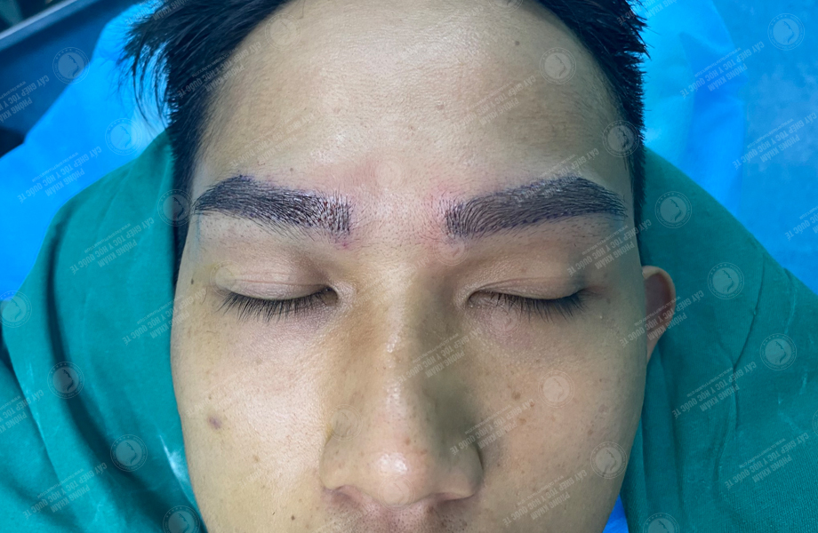 Hoàng Duy Phong - Cấy lông mày 5