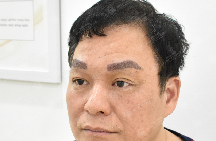 Phạm Tấn Sơn - Cấy lông mày 6