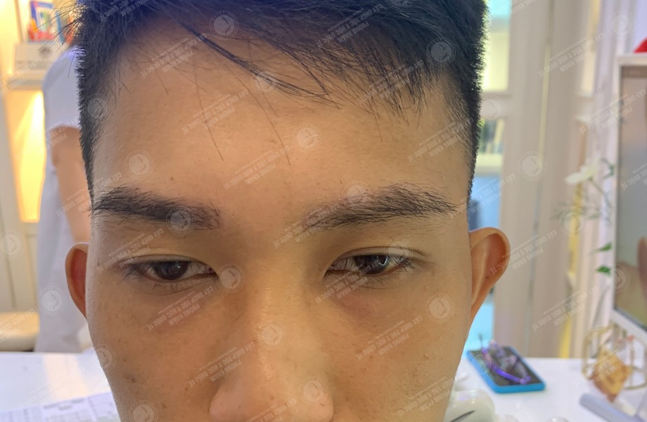 Hoàng Duy Phong - Cấy lông mày 6