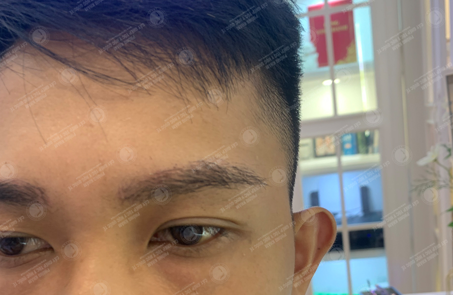 Hoàng Duy Phong - Cấy lông mày 7