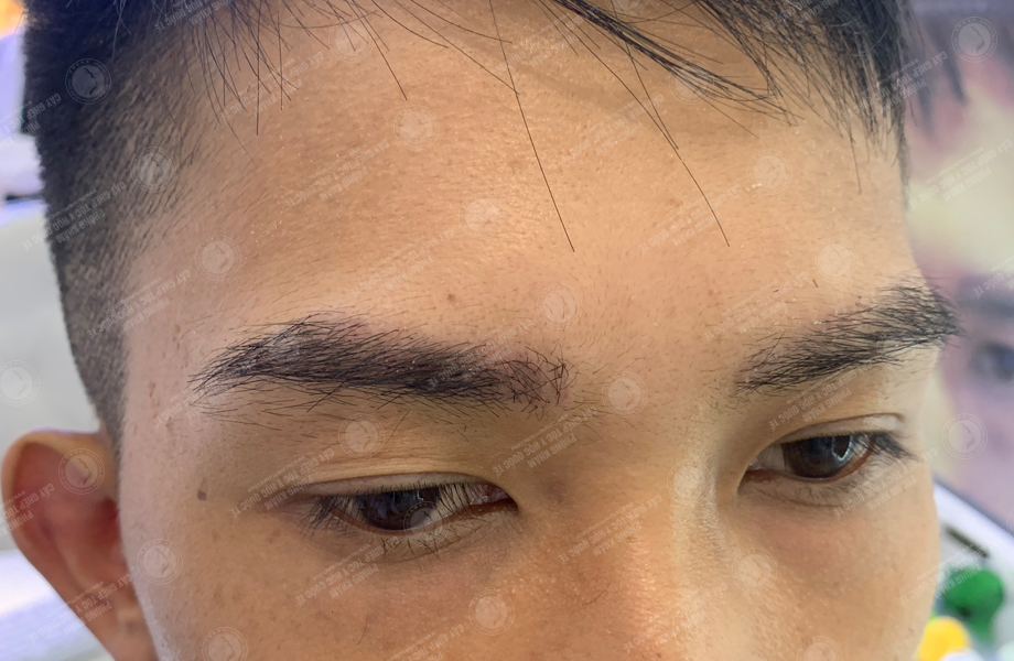 Hoàng Duy Phong - Cấy lông mày 8