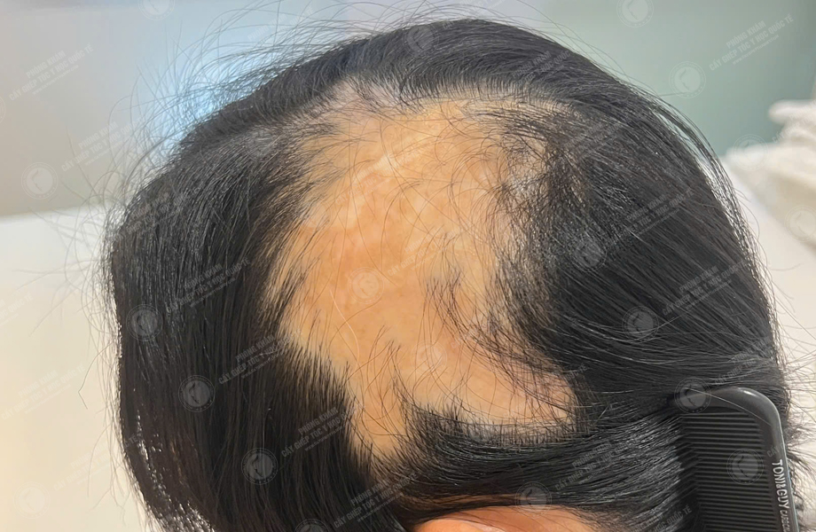Phạm Quang Sự - Cấy tóc trên sẹo 3