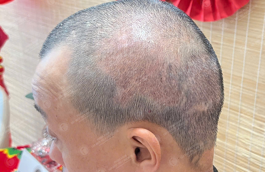 Phạm Quang Sự - Cấy tóc trên sẹo 5