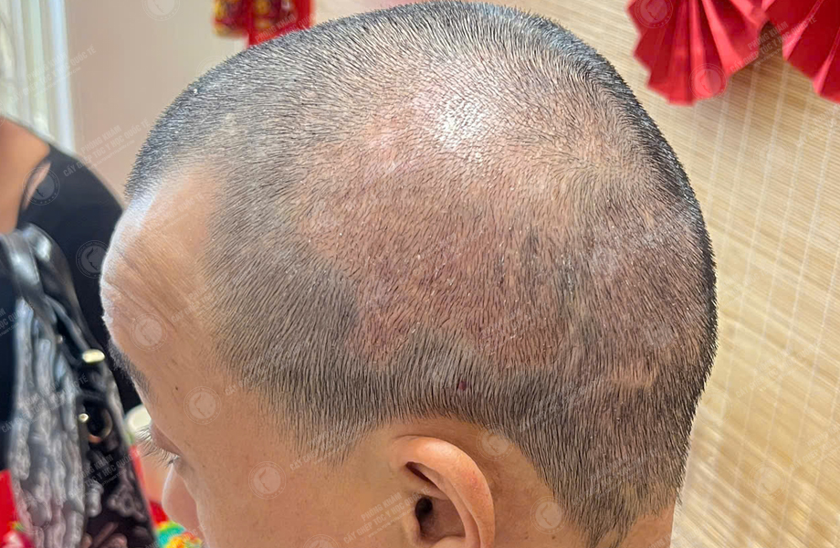 Phạm Quang Sự - Cấy tóc trên sẹo 6