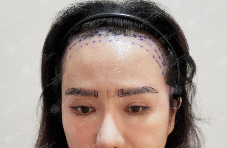 Nguyễn Thảo Phương - Cấy lông mày 2