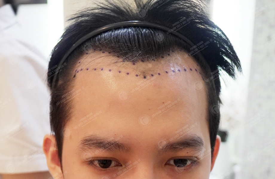 Nguyễn Thành Hưng - Cấy tóc đường chữ M 2