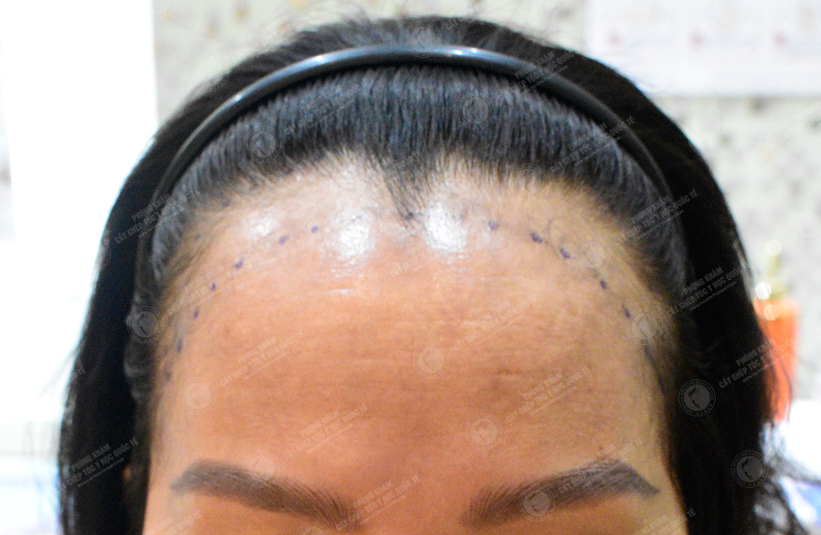 Phan Thị Tuyết - Cấy tóc đường chữ M 2